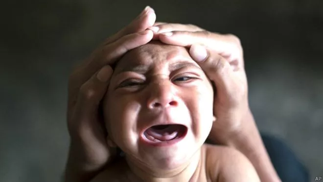MICROCEFALIA-ZIKA-SALUD-BRASIL